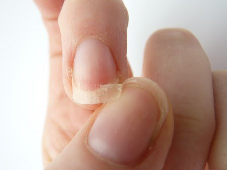 broken nail