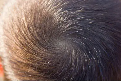 hair whorl