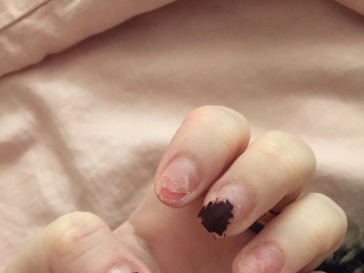 putting acrylic nails on damaged nails