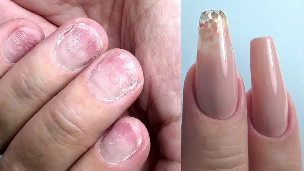 acute-nail-changes-after-manicure-with-acrylate-containing-nail-polish