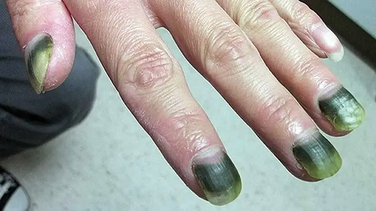 Why Are My Nails Green After Fake Nails: Fix It Now!